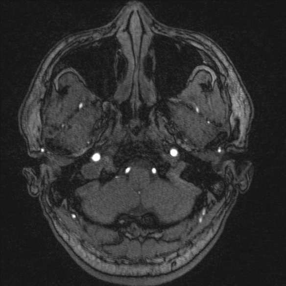Normal brain MRI including MRA (Radiopaedia 48748-53763 Axial MRA 15).jpg