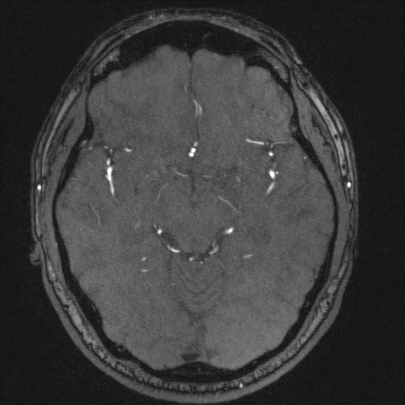 Normal brain MRI including MRA (Radiopaedia 48748-53763 Axial MRA 92).jpg