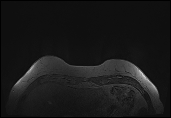File:Normal breast MRI - dense breasts (Radiopaedia 80454-93850 Axial T1 13).jpg
