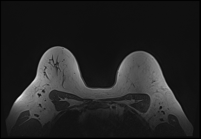 File:Normal breast MRI - dense breasts (Radiopaedia 80454-93850 Axial T1 177).jpg