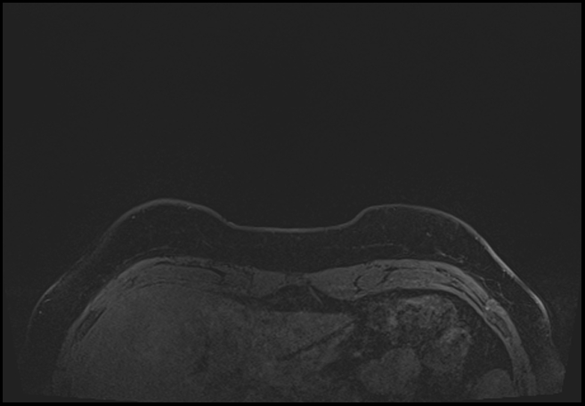 Normal breast MRI - dense breasts (Radiopaedia 80454-93850 C 5).jpg