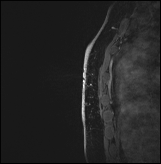 Normal breast MRI - dense breasts (Radiopaedia 80454-93850 I 163).jpg