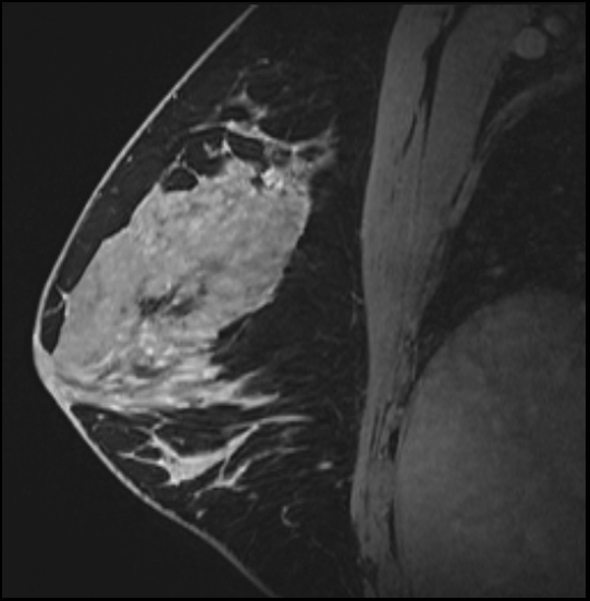 Normal breast MRI - dense breasts (Radiopaedia 80454-93850 I 97).jpg