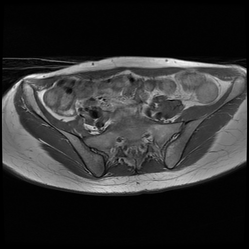 File:Normal female pelvis MRI (retroverted uterus) (Radiopaedia 61832-69933 Axial T1 8).jpg