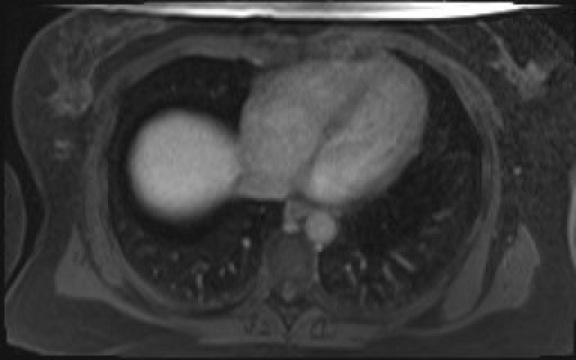 File:Normal hepatobiliary phase liver MRI (Radiopaedia 58968-66230 A 10).jpg