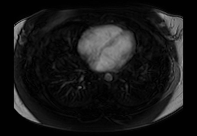 Normal liver MRI with Gadolinium (Radiopaedia 58913-66163 J 82).jpg