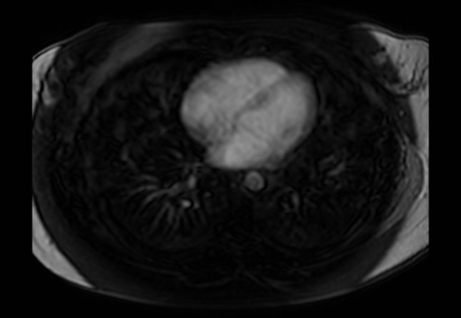 Normal liver MRI with Gadolinium (Radiopaedia 58913-66163 J 83).jpg