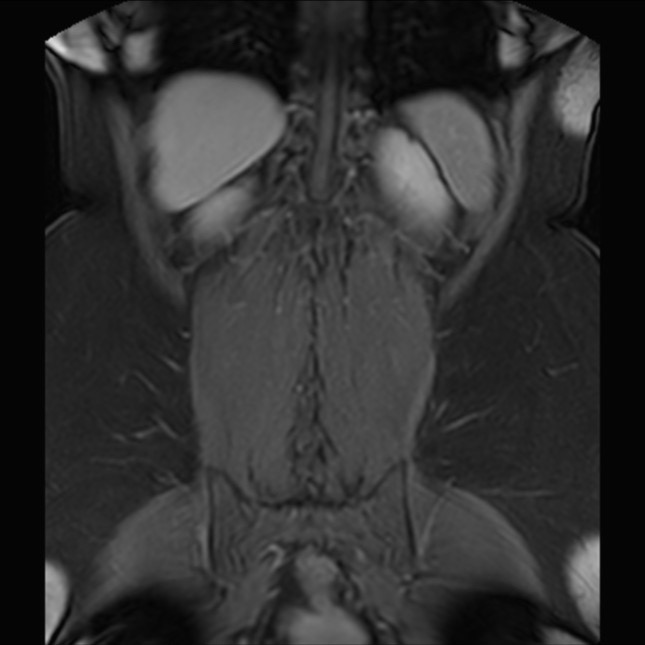 Normal liver MRI with Gadolinium (Radiopaedia 58913-66163 P 71).jpg