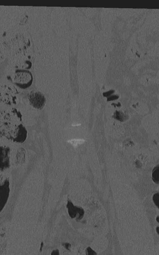 Normal lumbar spine CT (Radiopaedia 46533-50986 Coronal bone window 11).png