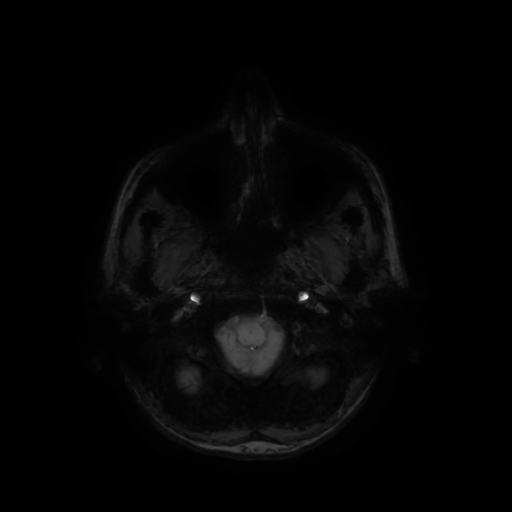 Normal noncontrast MR venography (Radiopaedia 87578-103957 Axial SWI 69).jpg