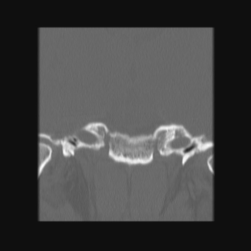 Normal sinus CT (annotated) (Radiopaedia 78917-91810 Coronal bone window 55).jpg