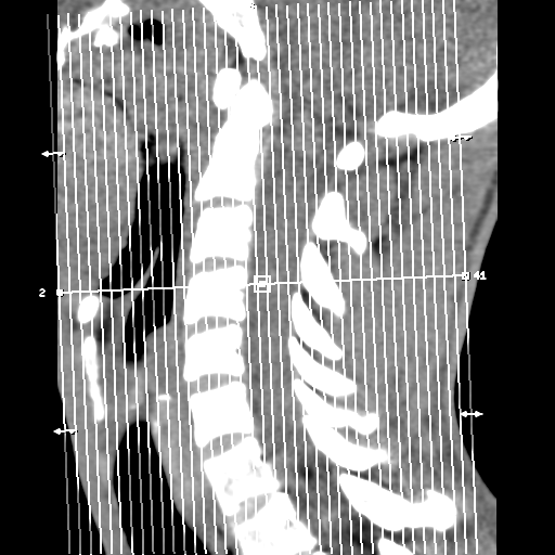 File:Normal trauma cervical spine (Radiopaedia 41017-43760 Coronal non-contrast 1).png