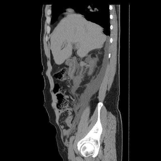 File:Obstructed kidney with perinephric urinoma (Radiopaedia 26889-27066 B 14).jpg