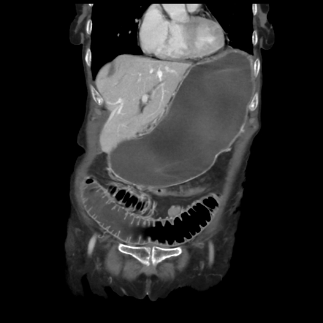 Obstructed obturator hernia (Radiopaedia 75197-86293 B 15).jpg