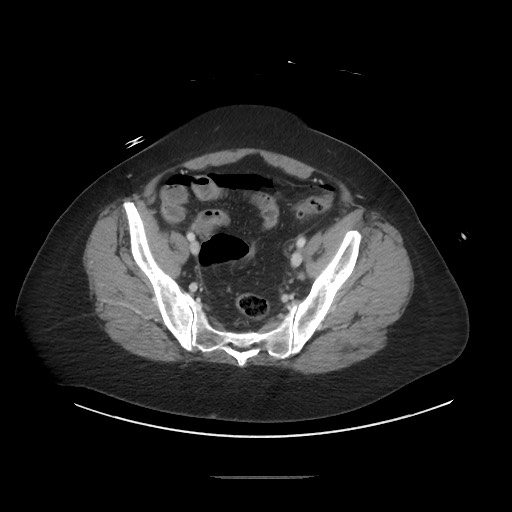Obstructive distal colonic adenocarcinoma causing cecal perforation (Radiopaedia 86830-102989 A 158).jpg