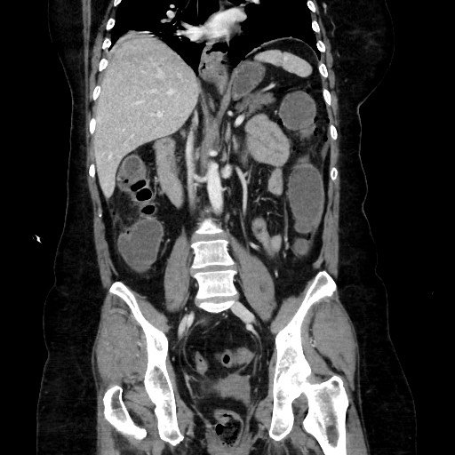 Obstructive distal colonic adenocarcinoma causing cecal perforation (Radiopaedia 86830-102989 C 108).jpg