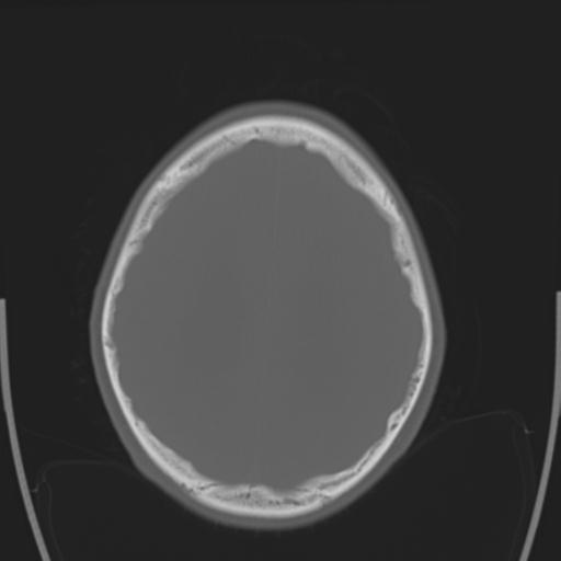 File:Obstructive hydrocephalus (Radiopaedia 30453-31119 Axial bone window 9).jpg
