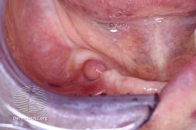 File:Oral fibroma (DermNet NZ site-age-specific-oral-fibroma).jpg