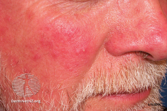 Rosacea (DermNet NZ acne-red-face-3617).jpg