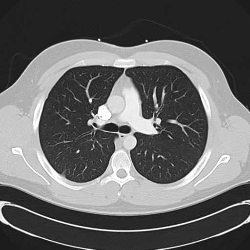 'Bovine' aortic arch (Radiopaedia 33554-34637 Axial lung window 24).png
