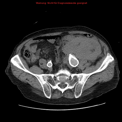 File:Abdominal aortic aneurysm- extremely large, ruptured (Radiopaedia 19882-19921 Axial C+ arterial phase 57).jpg
