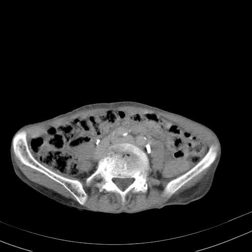 File:Abdominal aortic aneurysm (Radiopaedia 20827-20742 Axial C+ delayed 21).jpg