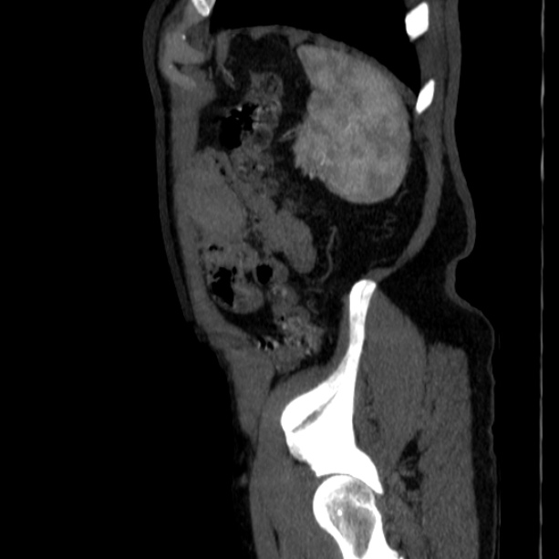 Abdominal aortic aneurysm (Radiopaedia 29248-29660 Sagittal C+ arterial phase 49).jpg
