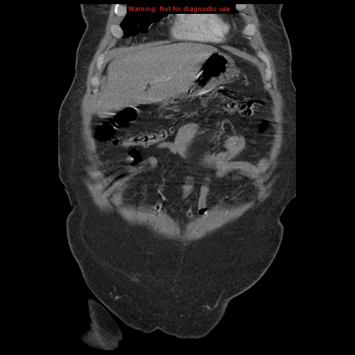 Abdominal aortic aneurysm (Radiopaedia 8190-9038 Coronal C+ arterial phase 23).jpg