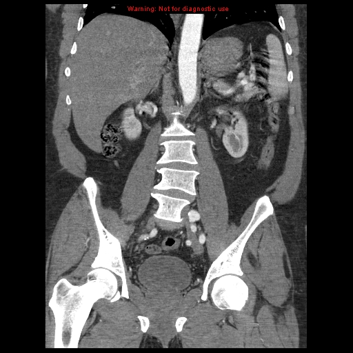 Abdominal aortic aneurysm (Radiopaedia 8190-9038 Coronal C+ arterial phase 76).jpg