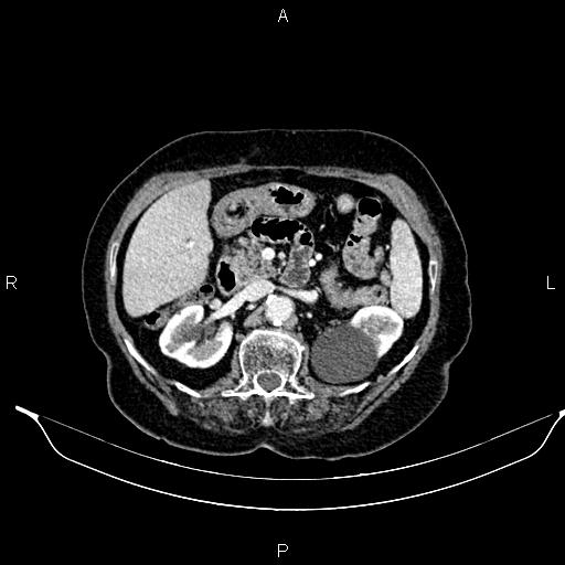File:Abdominal aortic aneurysm (Radiopaedia 85063-100606 Axial C+ portal venous phase 36).jpg
