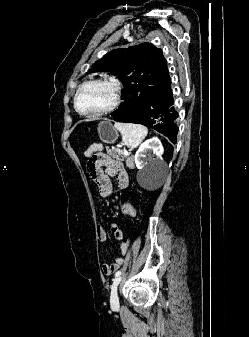 Abdominal aortic aneurysm (Radiopaedia 85063-100606 Sagittal C+ arterial phase 63).jpg
