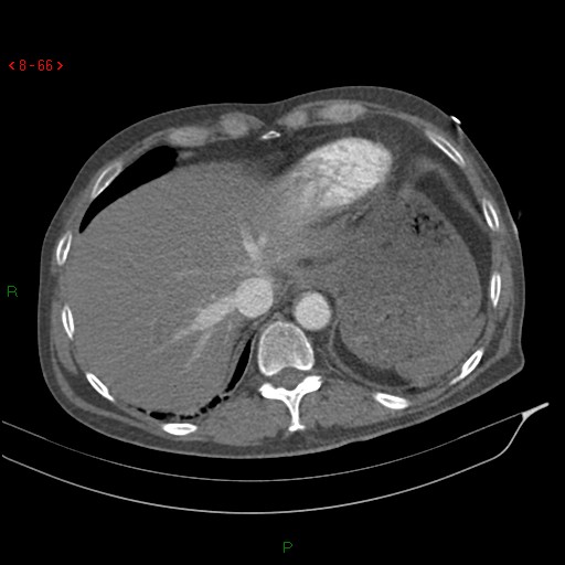 Abdominal aortic aneurysm rupture with aortocaval fistula (Radiopaedia 14897-14841 Axial C+ arterial phase 66).jpg