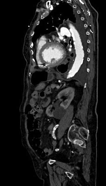 Abdominal aortic aneurysm with thrombus fissuration (Radiopaedia 73192-83919 Sagittal C+ arterial phase 44).jpg