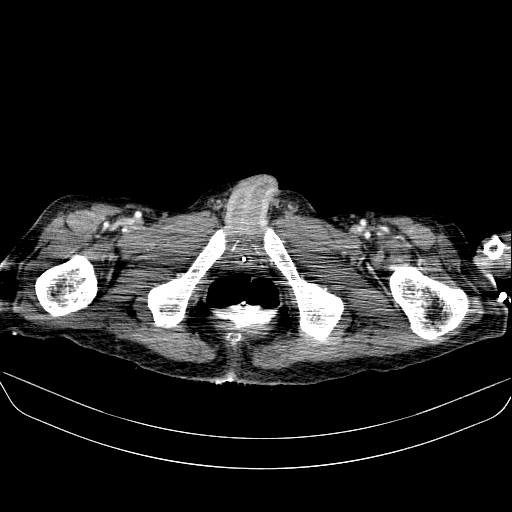 File:Abdominal collection due to previous cecal perforation (Radiopaedia 80831-94320 Axial C+ portal venous phase 220).jpg