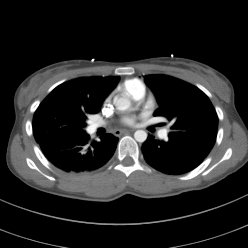 File:Abdominal multi-trauma - devascularised kidney and liver, spleen and pancreatic lacerations (Radiopaedia 34984-36486 Axial C+ arterial phase 41).png