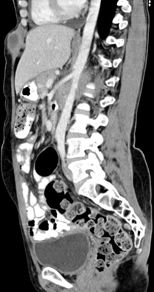 Abdominal wall and retroperitoneal tuberculosis (Radiopaedia 88137-104729 Sagittal C+ portal venous phase 69).jpg