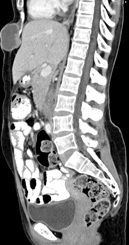 Abdominal wall and retroperitoneal tuberculosis (Radiopaedia 88137-104729 Sagittal C+ portal venous phase 79).jpg