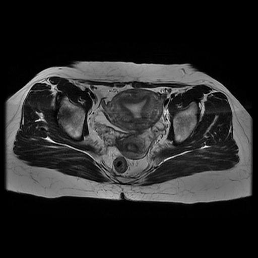 File:Abdominal wall endometriosis (Radiopaedia 83702-98847 Axial T2 11).jpg
