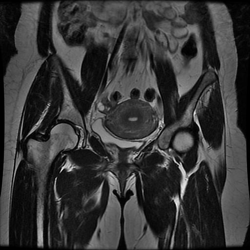 File:Abdominal wall endometriosis (Radiopaedia 83702-98847 Coronal T2 7).jpg