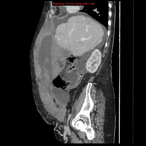 Abdominal wall hematoma (Radiopaedia 9427-10112 Sagittal C+ portal venous phase 76).jpg