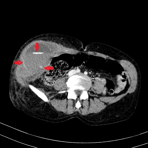File:Abdominal wall hematoma with active bleeding (Radiopaedia 83915-99122 Axial contrast-enhanced CT 45).jpg