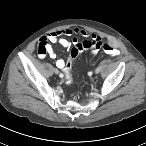 Abdominal wall metastasis from colorectal carcinoma (Radiopaedia 31016-31717 Axial C+ portal venous phase 62).jpg