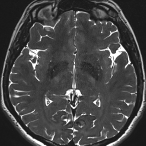 Abducens nerve palsy (Radiopaedia 51069-56648 Axial T2 fat sat 91).png