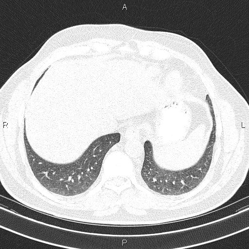 Aberrant right subclavian artery (Radiopaedia 87093-103354 Axial lung window 90).jpg