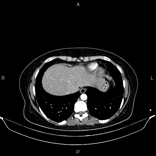 Aberrant right subclavian artery (Radiopaedia 87334-103629 Axial C+ arterial phase 52).jpg