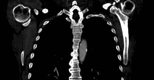 Accesory rib joint (Radiopaedia 71987-82452 Coronal bone window 27).jpg