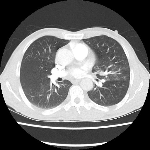 Accessory left horizontal fissure with lingular pneumonia (Radiopaedia 53763-59843 Axial lung window 30).jpg