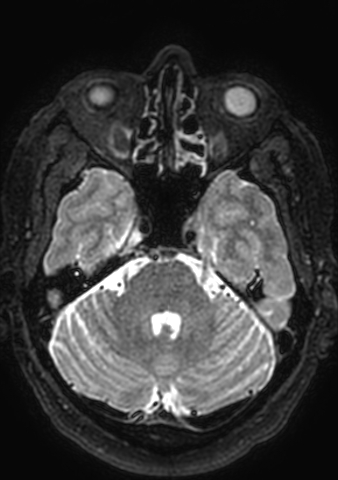 File:Accessory middle cerebral artery (Radiopaedia 73114-83828 Axial T2 153).jpg