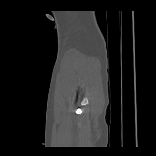 File:Acetabular and ilial fractures (Radiopaedia 59084-66378 Sagittal bone window 98).jpg