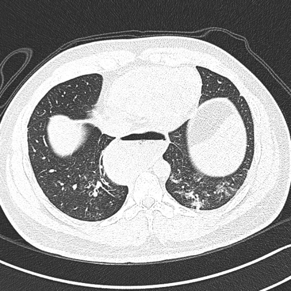 File:Achalasia with aspiration (Radiopaedia 55413-61845 Axial lung window 56).jpg